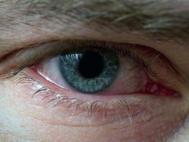 Покраснение г. Покраснение глаз. Профилактические меры против покраснений глазных белков